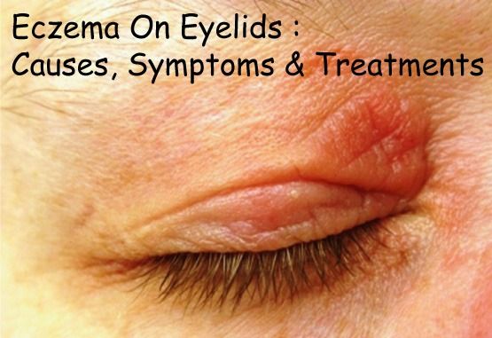 Eczema On Eyelids : Causes, Symptoms & Treatments | Disfreeskin How To Get Rid Of A Stye On Your Eyelid, Dry Eyelids Remedy, Wrinkly Eyelids, Dry Eye Remedies, Itchy Eyelids, Dry Eyelids, Red Rash, Dry Eye, Home Health Remedies