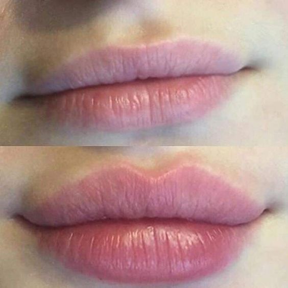 Needleless Lip Filler, Korean Lip Filler Before And After, Lip Filler Shape Ideas Pouty, Desired Lips, Lip Fillers Juvederm, Dermal Fillers Lips, Juvederm Lips, Lips Inspiration, Permanente Make-up