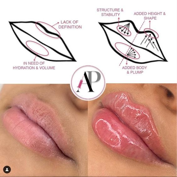 Lip Fillers Juvederm, Dermal Fillers Lips, Facial Injections, Pdo Threads, Lips Inspiration, Botox Lips, Aesthetic Dermatology, Audrey Rose, Botox Cosmetic