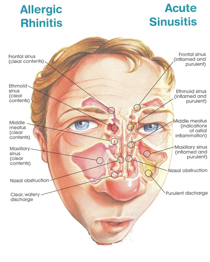 Sinus Medicine, Acute Sinusitis, Remedy For Sinus Congestion, Maxillary Sinus, Sinus Congestion Relief, Congestion Relief, Allergic Rhinitis, Sinus Congestion, Medical Anatomy