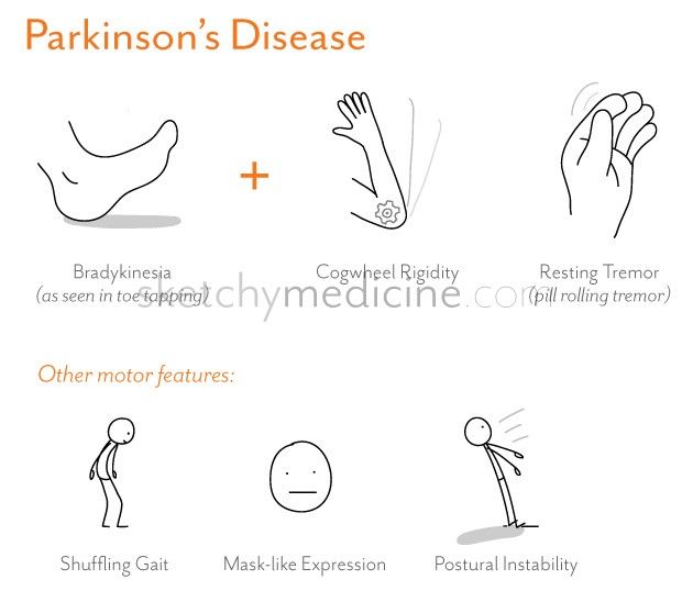 parkinsons_disease Neuro Exam, Neuro Assessment, Nursing Iv, Psych Nursing, Medicine Aesthetic, Substantia Nigra, Parkinson Disease, Parkinsons Awareness, Nursing Exam