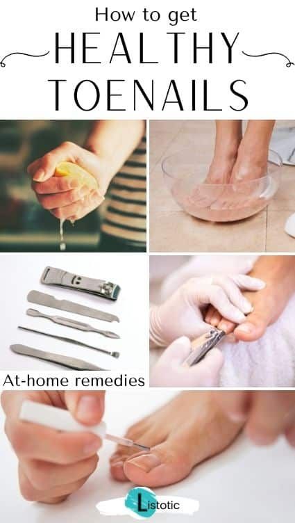 Learn how to get healthier toenails with this list! Read everything from proper trimming techniques to how to get rid of toenail fungus using home remedies. Click on the pin to see the full guide to toenail care featured on Listotic! Brittle Toenails, Toenail Care, Healthy Toenails, Toenail Health, Nail Whitening, How To Get Healthy, Fungal Nail, Brittle Nails, Ingrown Toe Nail