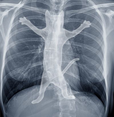 an x - ray image of a man's torso