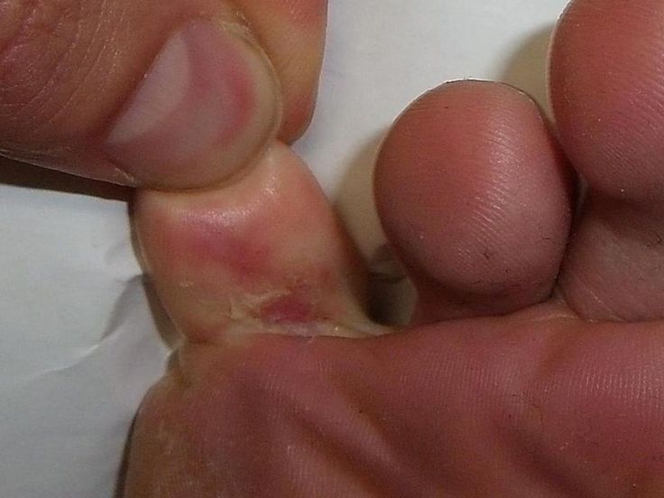 Toenail Fungus Remedies, Nail Fungus Remedy, Fungal Nail, Athletes Foot, Toenail Fungus, Nail Fungus, Natural Home Remedies, Health Remedies, Home Remedies