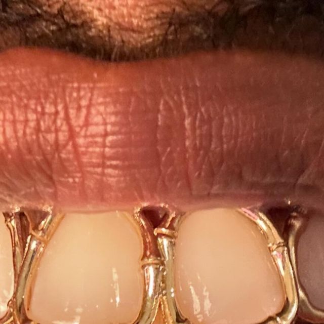 a man's mouth with three different types of gums on the upper part of his mouth