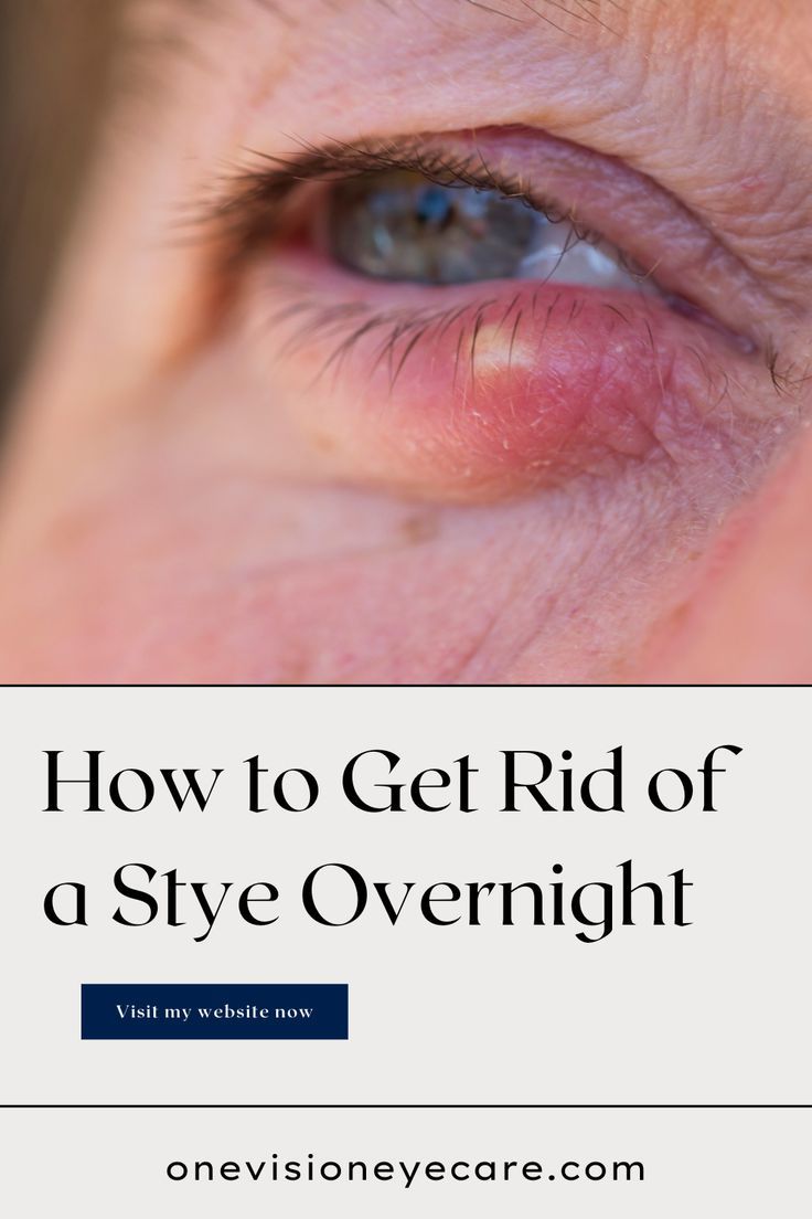 A lot of things can cause a stye, and some are completely in your control. In this article, I am going to cover things you can do to help prevent styes and at the end I’ll give you my tip on how to get rid of a stye overnight. Sty Remedy How To Get Rid, Sty In The Eye Remedies How To Get Rid, Get Rid Of A Stye Overnight, What Causes A Stye In Your Eye, How To Get Rid Of Stye Eye, How To Get Rid Of A Stye On Your Eyelid, Remedies For Stye On Eyelid, Eyelid Irritation Remedies, Sty Eye Remedies How To Get Rid