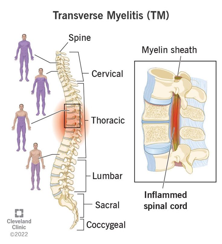 Transverse Myelitis, Spinal Fluid, Sjogrens Syndrome, Muscle Weakness, Medical Anatomy, Cleveland Clinic, Autoimmune Disorder, Neurological Disorders, Spinal Cord