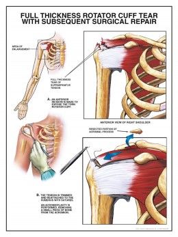 Shoulder Anatomy, Rotator Cuff Surgery, Rotator Cuff Exercises, Shoulder Rehab, Rotator Cuff Tear, Rotator Cuff Injury, Physical Therapy Exercises, Shoulder Surgery, Frozen Shoulder