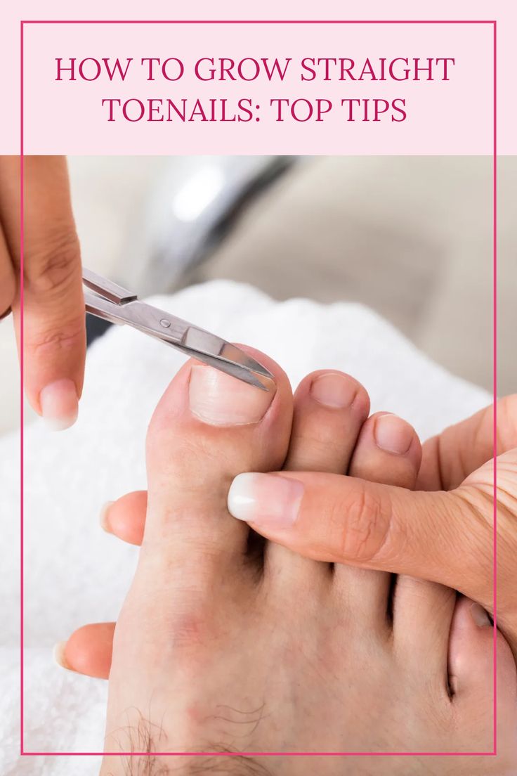 Discover the best ways to promote straight toenail growth and prevent ingrown toenails. Click to learn more! How To Get Healthy Toenails, Toenail Growth Fast, How To Whiten Toenails, Ingrown Toenail Remedy, Ingrown Toenail Remedies, Healthy Toenails, Toenail Health, Toenail Fungal Infection, Nail Remedies