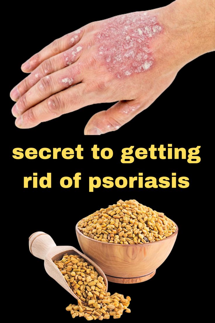 my grandmother's secret to getting rid of psoriasis at home Psoriatic Skin Natural Remedies, Psoriatic Skin Remedies, Psoriatic Skin, Dry Skin Home Remedies, Home Remedies For Skin, Skin Natural Remedies, Healthy Herbs, Skin Remedies, Natural Health Remedies