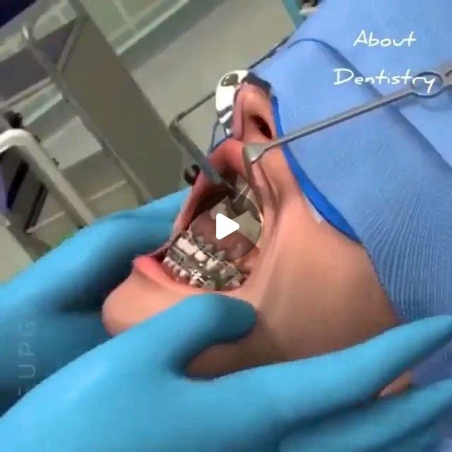 Corrective Jaw Surgery, Orthognathic Surgery, Jaw Surgery, Smile Teeth, Dental Surgery, Healthy Smile, Dental Hygiene, Toothless, Visual Representation