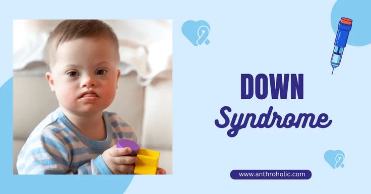 Down syndrome, also known as trisomy 21, is a genetic disorder caused by the presence of an extra 21st Edwards Syndrome, Genetic Disorders, Genetic, Anthropology, Parenting, Human