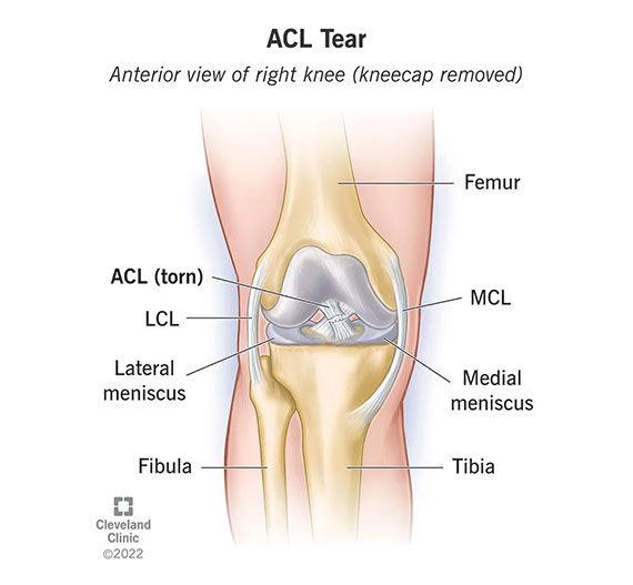 The ACL is the most commonly injured knee ligament. Sports injuries usually cause ACL tears. If you tear your ACL, you’ll probably need surgery to repair it. Most people who tear their ACL make a full recovery and resume playing sports with no long-term consequences. The recovery time for a torn ACL is usually six to nine months. Acl Tear Symptoms, Acl Knee, Acl Injury, Torn Acl, Knee Ligaments, Medical Illustrations, Acl Surgery, Anterior Cruciate Ligament, Ligament Tear