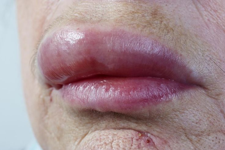 Swollen Lip Remedy, Allergic Reaction Remedies, Lip Allergy, Blister On Lip, Sunburned Lips, Swollen Lips, Sore Lips, Swollen Face, Fever Blister