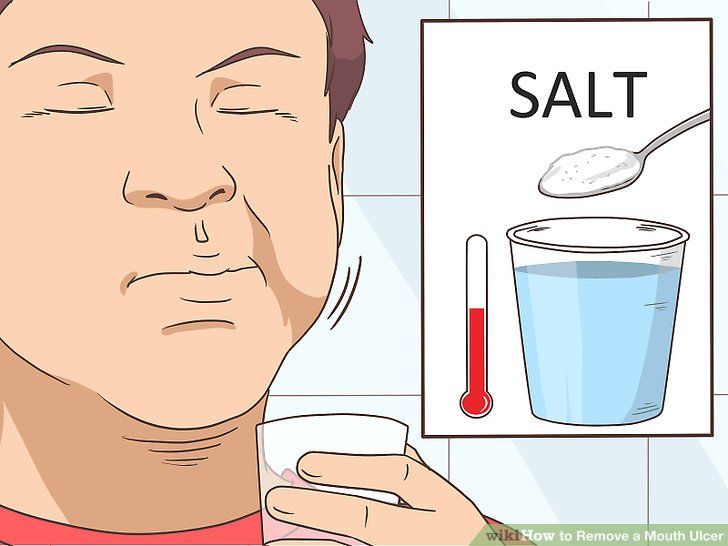 3 Ways to Remove a Mouth Ulcer - wikiHow How To Get Rid Of Mouth Ulcers, Sore In Mouth Remedies, Ulcer On Tongue, Ulcer Remedies Mouth, Mouth Sore, Canker Sore Remedy, Mouth Ulcer, Tongue Sores, Home Remedies For Bronchitis