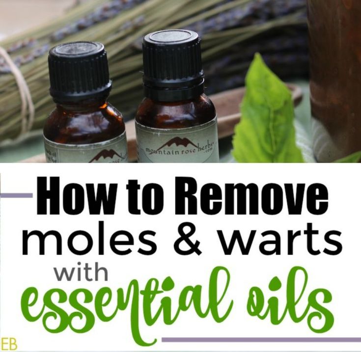 How to Remove Moles and Warts with Essential Oils How To Remove Moles, Remove Moles, Warts On Hands, Warts On Face, Eat Beautiful, Rose Leslie, Skin Moles, Mole Removal, Losing 40 Pounds