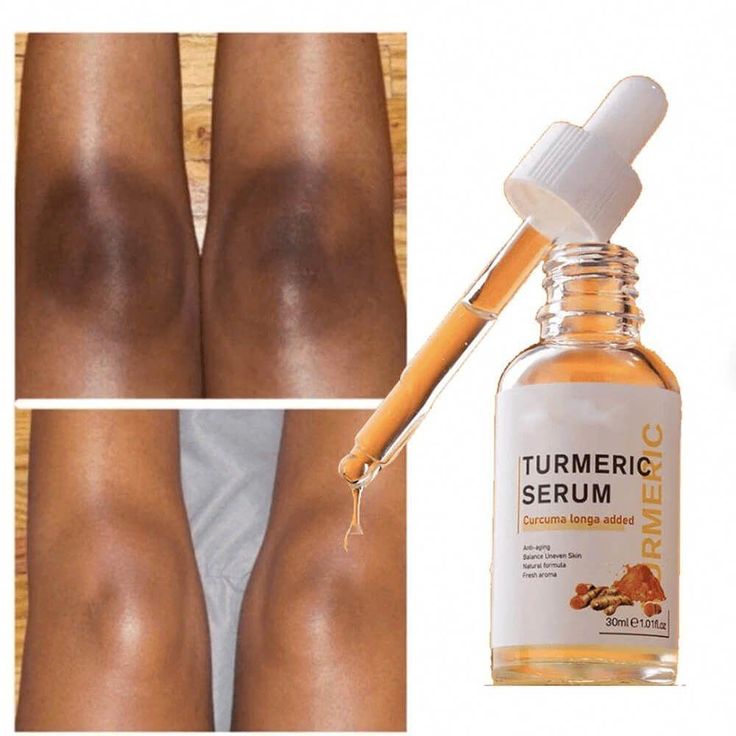 Entferner für dunkle Flecken. Mit dem Dark Mark Remover können Sie sich von ungleichmäßigen Hauttönen verabschieden und einen helleren, gleichmäßigeren Teint genießen. Weltweiter Versand. Skin Lightening Remedies, Face Whitening Serum, Turmeric Serum, Oily Skin Remedy, Dark Spot Serum, Dior Jadore, Dark Spots On Skin, Dark Spot Corrector, Skin Lightening