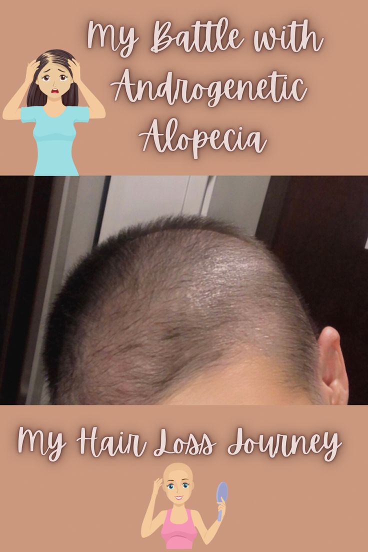 Myself with a bald head. Grow Hair Back, Alopecia Hair Growth, Alopecia Hairstyles, Androgenic Alopecia, Traction Alopecia, Female Pattern Baldness, Androgenetic Alopecia, Loss Hair, Scalp Serum