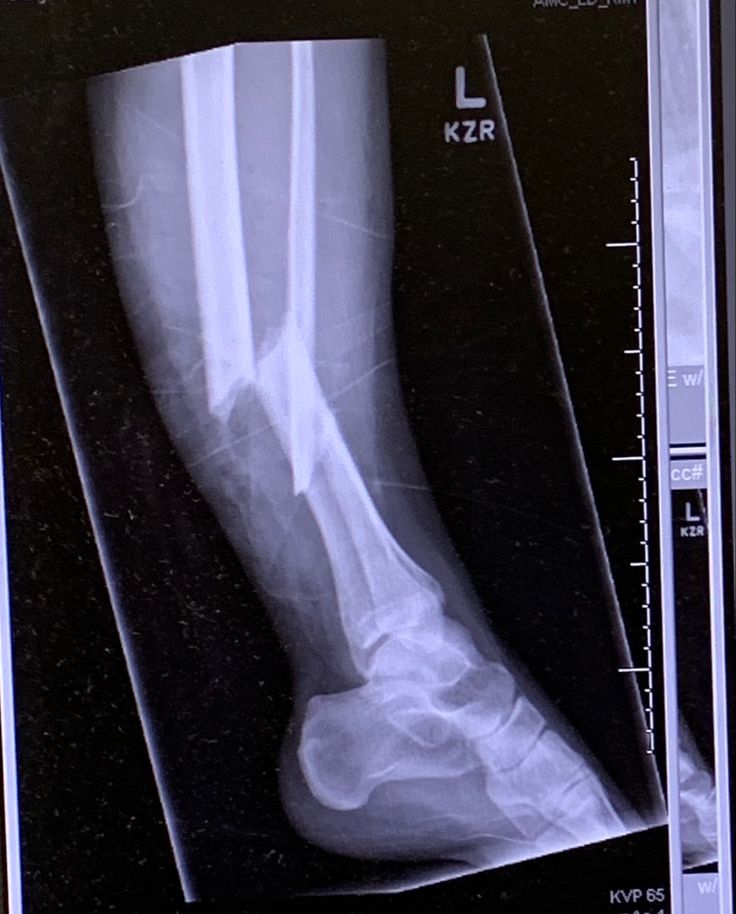 an x - ray image of a foot with the lower leg showing bones marked in white