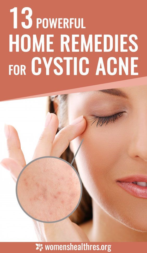 Skin Care Procedures, Cystic Acne Remedies, Acne Treatments, Natural Acne Remedies, Natural Acne, Types Of Acne, Acne Problem, Moisturizer For Oily Skin, Hormonal Acne