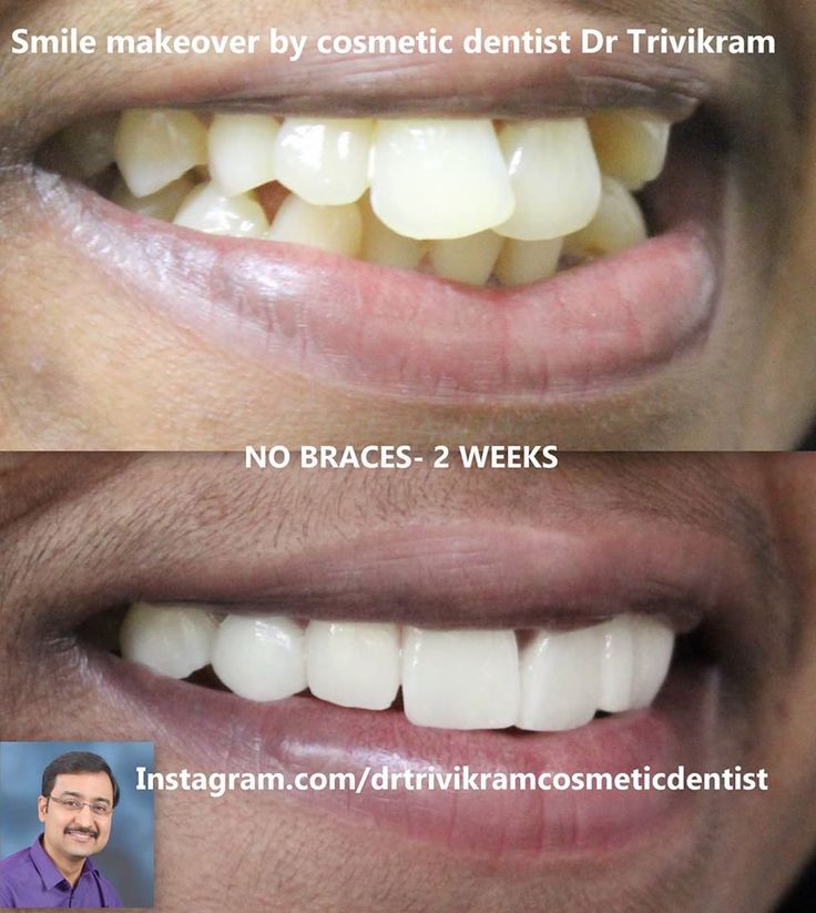 Crowding Teeth, Teeth With Braces, Attractive Smile, After Braces, Teeth Doctor, Dentist Doctor, Teeth Whitening Toothpaste, Crooked Teeth, Teeth Bleaching