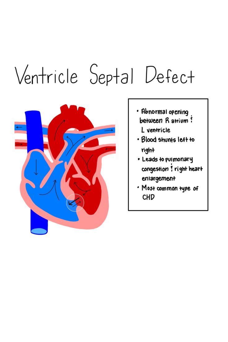 an image of the heart with words describing how to use it for ventrical defect