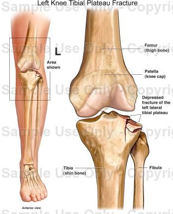 Knee Fracture, Tibial Plateau Fracture, Broken Knee, Knee Bones, Shoulder Rehab, Spine Care, Bone Fracture, Leg Injury, Bone Diseases