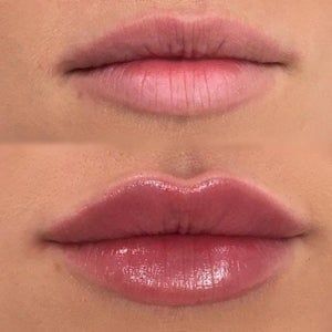 Lip Fillers Juvederm, Lips Inspiration, Permanente Make-up, Face Fillers, Botox Lips, Facial Fillers, Lip Augmentation, Facial Aesthetics, Lip Filler