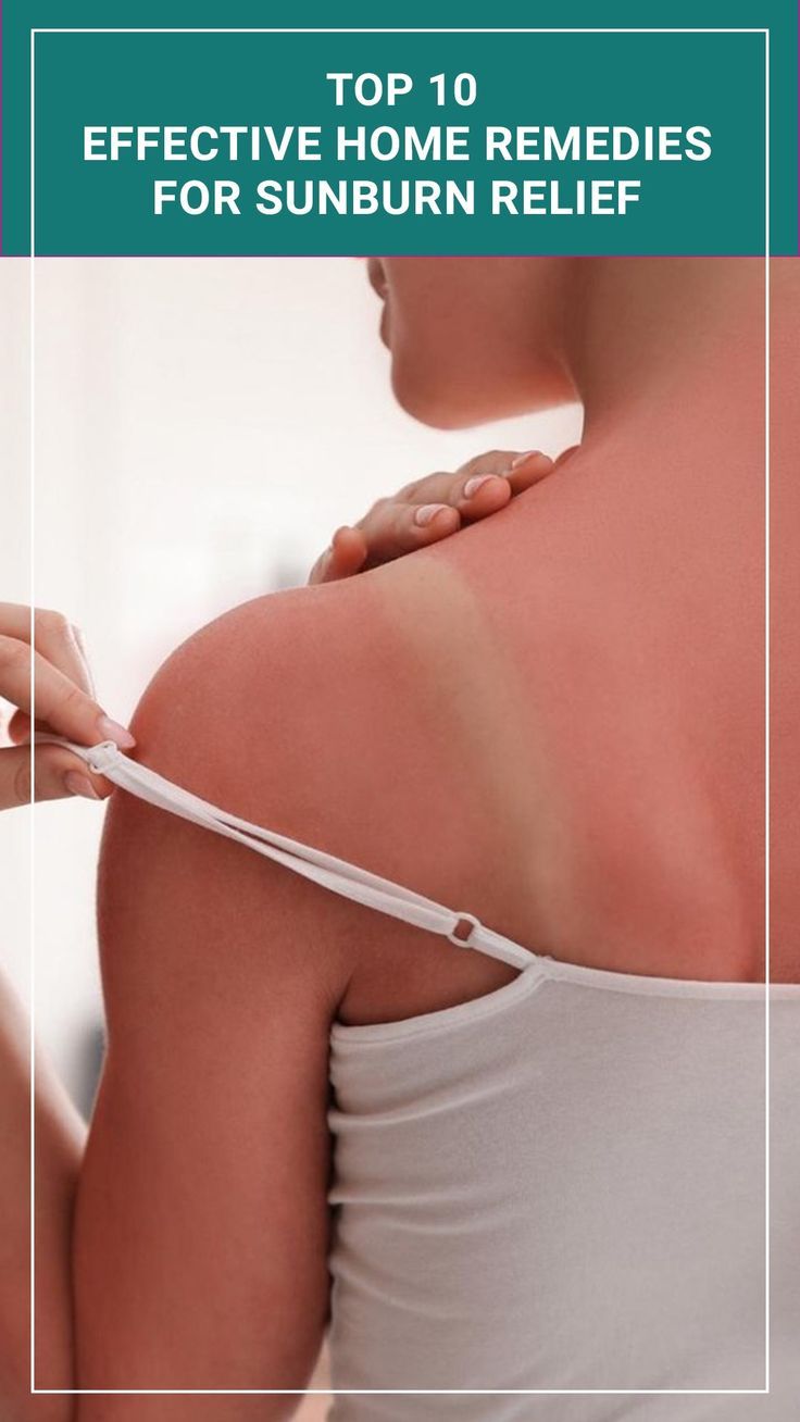 There are many ways to treat sunburn, but home remedies can be just as effective. Some simple home remedies for sunburn relief include Remedies For Sunburn, Home Remedies For Sunburn, Get Rid Of Sunburn, Sunburn Remedies, Sunburn Relief, Simple Home, Holistic Wellness, Simple House, Emotional Health