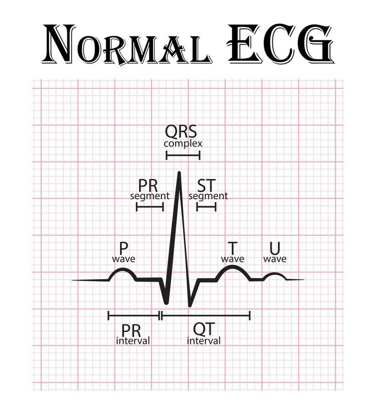 Cath Lab Nursing, Normal Ecg, St Elevation, Med School Study, Ecg Interpretation, Medical Assistant Student, Pr Interval, Radiology Student, Coran Quotes