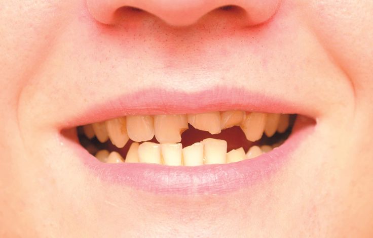 Chipped and cracked teeth are among the most common traumatic dental injuries. But teeth that are treated appropriately—and in a timely manner—have the best chance for a full recovery. #broken #tooth #emergency Broken Teeth, Cracked Tooth, Teeth Covers, Chipped Tooth, Healthy Life Hacks, Dental Emergency, Loose Tooth, Teeth Implants, Dental Teeth