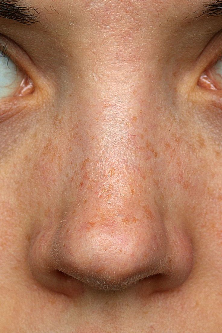 a woman's face with freckles on her eyes and nose, looking at the camera