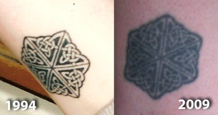 before and after photos of tattoo removals on the arm, from left to right