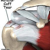 Rotator Cuff Rehab, Shoulder Anatomy, Rotator Cuff Surgery, Rotator Cuff Exercises, Psoas Release, Shoulder Rehab, Rotator Cuff Tear, Rotator Cuff Injury, Shoulder Surgery