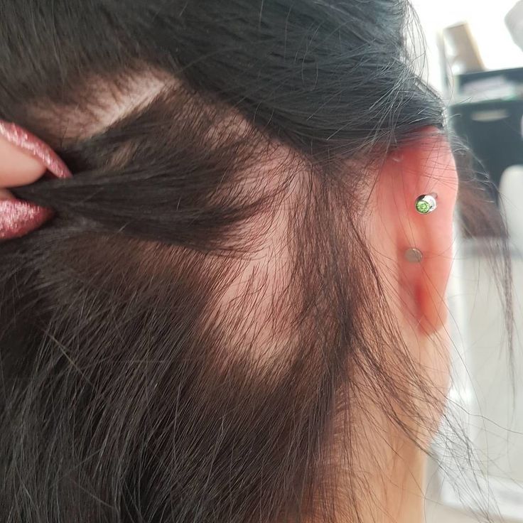 Traction Alopecia: How to Prevent and Fix It | Allure Traction Alopecia Regrowth, Vitamins For Hair, Traction Alopecia, How To Grow Your Hair Faster, Bald Spot, Regrow Hair, New Hair Growth, Lost Hair, Your Hairstyle