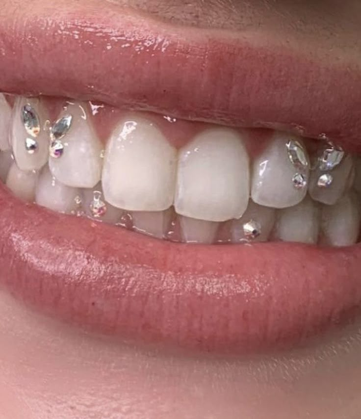 a woman's smile with braces and diamonds on the upper part of her teeth