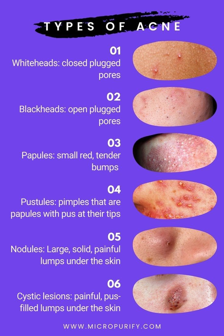 Papules Acne, Different Types Of Acne, Blind Pimple, Moderate Acne, Mild Acne, Forehead Acne, Pimples Under The Skin, Lotion For Oily Skin, Blue Light Therapy