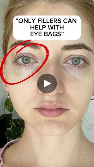 15K views · 235 reactions | Transformed my eye bags with face fitness I’ve created a stories highlight “eye bags” to share how you can do it too! #eyebags #puffyeyes #facefitness #faceyoga #glowuptips Disclaimer: not a medical advice. For education purpose only. Consult with your physician if you have a medical condition. | Valeriia Veksler | XZIIE · Streets Face Fitness, Remove Dark Circles, Dark Circles Under Eyes, Face Yoga, Glow Up Tips, Puffy Eyes, Eye Bags, Story Highlights, Medical Advice