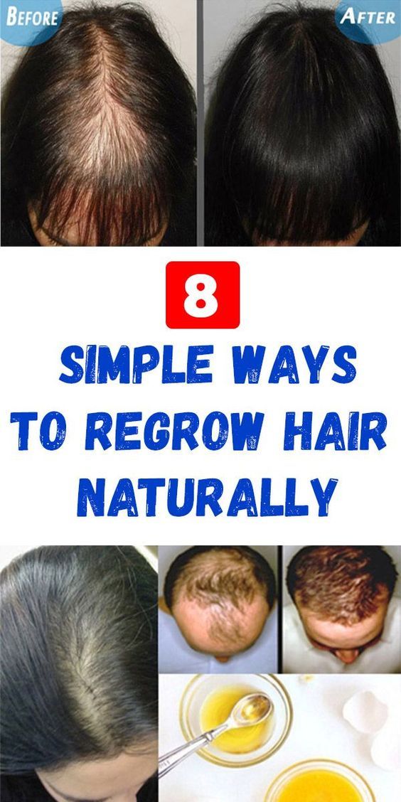 8 Tips to Naturally Regrow Your Hair Faster Regrow Hairline, Regrow Hair Naturally, Hair Growing Tips, Hair Remedies For Growth, Home Remedies For Hair, Regrow Hair, New Hair Growth, Lost Hair, Grow Hair Faster