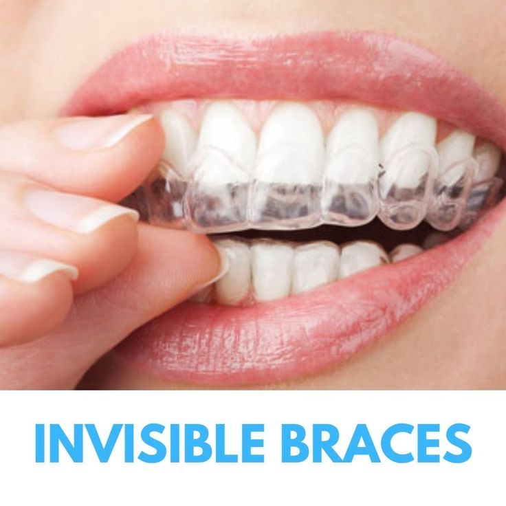 You are not a fan of wearing the old traditional metal braces, Dentist in maroubra brings in another option that might just work for you. Invisible braces are a series of removable and virtually invisible clear aligners which gently move and straighten your teeth over time. Invisalign transparent braces straighten your teeth using a series of invisible custom-moulded, removable aligners. Invisible Braces Teeth, Transparent Braces, Invisible Teeth Braces, Braces Dentist, Removable Braces, Fixed Braces, Invisalign Aligners, Invisible Braces, Clear Aligners