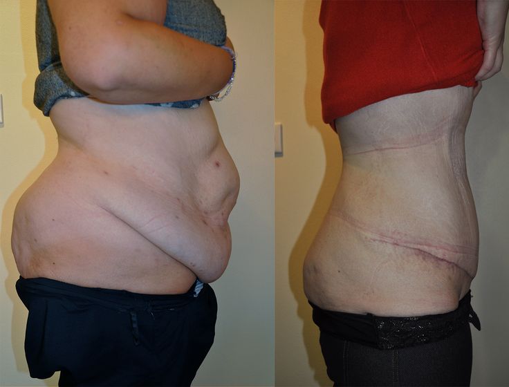 tummy tuck before after abdominoplasty Plus Size Tummy Tucks Before And After, Stomach Lipo Before And After, Tummy Tucks Before And After, Exercises After Abdominal Surgery, Abdominal Surgery Recovery Tips, Mommy Makeover Surgery Before And After Tummy Tucks, Body Lift Surgery, Skin Removal Surgery, Tummy Tucks Recovery