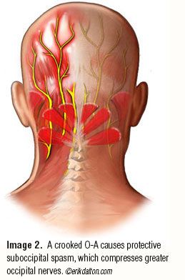 Forward Head Posture Exercises, Occipital Neuralgia, Head Pain, Headache Relief, Good Health Tips, Nerve Pain, Best Health, Shoulder Pain, Reflexology