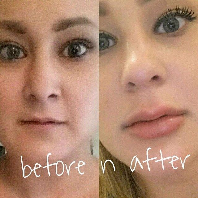 Before and After picture of syringe of Juvederm to the Lips....call to schedule your appointment today! (800)788-1416 Lip Injections Juvederm, Lip Goals, Skin Peeling On Face, Beauty Enhancement, Lips Inspiration, Nurse Injector, Plastic Fantastic, Lip Augmentation, Turning 40