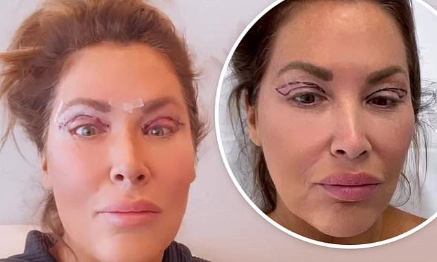 RHOC star Emily Simpson shares videos of her upper eyelid surgery Upper Eyelid Lift Surgery, Eyelid Lift Surgery Before After, Eye Lid Surgery Before And After, Eyelid Surgeries, Hooded Eye Surgery, Emily Simpson, Surgical Gown, Tamra Judge, Jeff Lewis