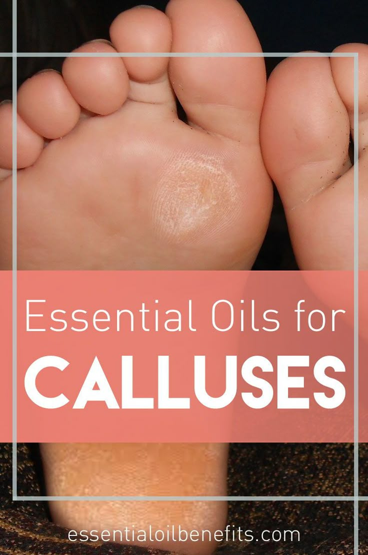 Essential oils for calluses. How to remove calluses with essential oils. How to get ride of calluses naturally. Callus Remover Diy, Feet Care Calluses, Essential Oils For Healing, Oils For Healing, Callous Remover, Foot Soak Recipe, Oregano Essential Oil, Essential Oils For Pain, Diy Home Remedies