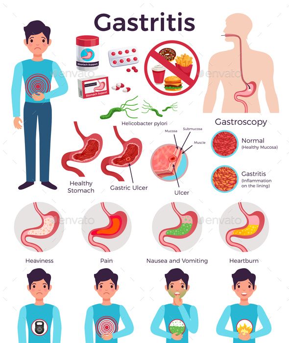 Gastritis Infographic Elements Set #Infographic, #Gastritis, #Set, #Elements Stomach Bacteria, Flat Infographic, Healthy Stomach, Gastric Problem, Infographic Elements, Stomach Ulcers, Disease Symptoms, Natural Antibiotics, Medical Illustration