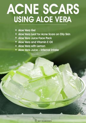 How to Clear Acne Scars using Aloe Vera - DIY Natural Home Remedies  Aloe vera, also called as Plant of life is a very effective natural remedy for treating acne and the acne scars on the skin. Regular usage of aloe vera will significantly reduce the visibility of scars and makes you feel more confident in your skin. Aloe Vera Diy, Benefits Of, Treating Acne, Natural Acne, Treat Acne, Acne Scar Removal, Stretch Mark, Hair Treatments, Face Beauty