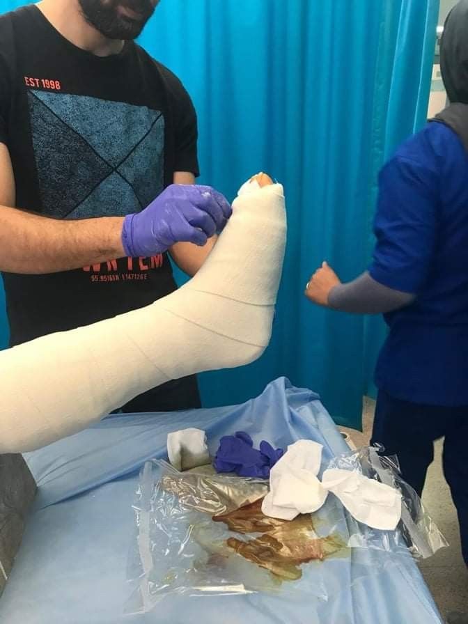 a man with a cast on his arm is getting bandaged up to another person's leg