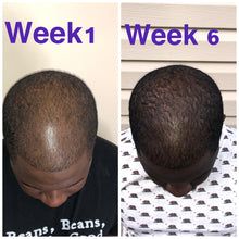 Receding Hair, Thinning Hairline, Shea Butter Moisturizer, Receding Hair Styles, Natural Hair Growth Oil, Hair Butter, Extreme Hair Growth, Dry Brittle Hair, Hair Growth Secrets