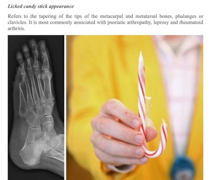 a person holding a candy cane in their left hand and an x - ray image on the right